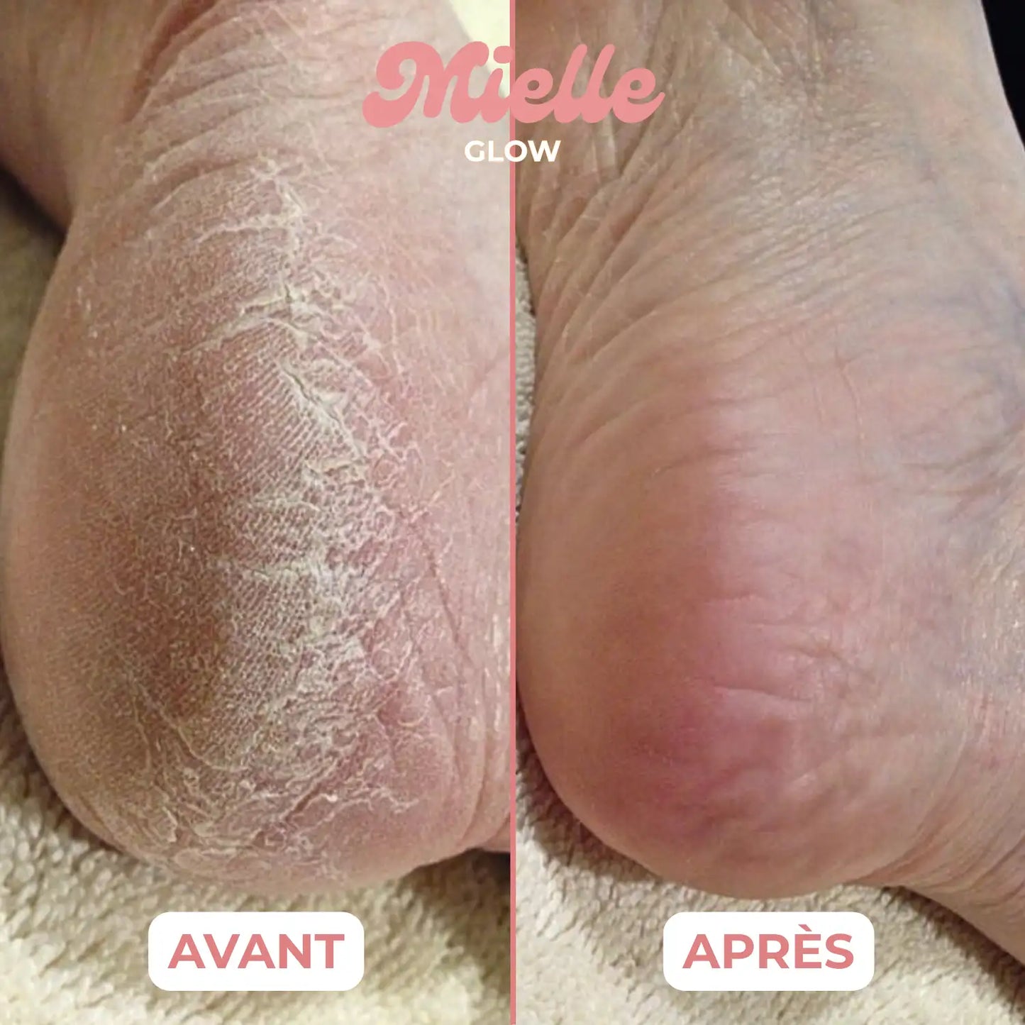 🍯 HoneyBalm™ – Baume Hydratant au Miel pour les pieds