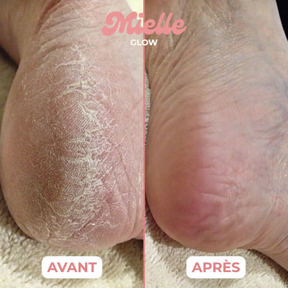 🍯 HoneyBalm™ – Baume Hydratant au Miel pour les pieds